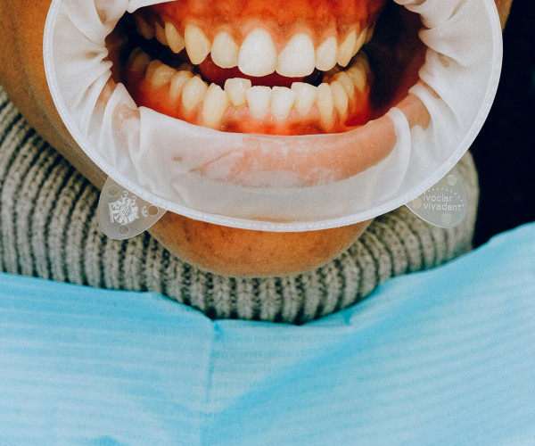 Implants dentaires – la meilleure chose à faire de votre santé dentaire